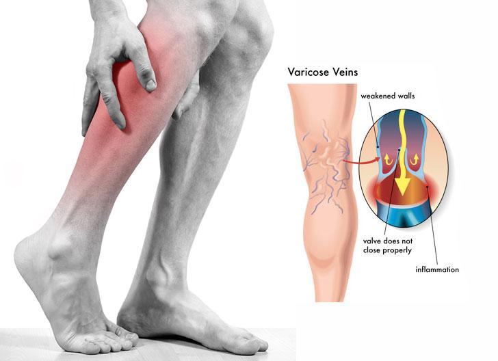 varicose-veins-and-excercise